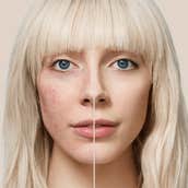 Foundations for Rosacea That Help Calm Redness, Not Trigger It